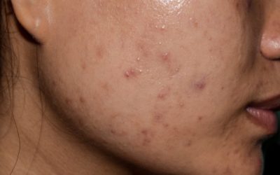 Accutane Benefits and Side Effects