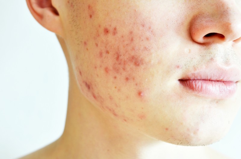 Is Accutane Right for You?